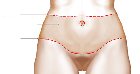 bodylift2