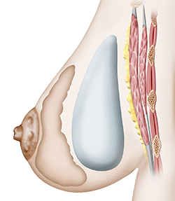 Augmentation mammaire