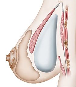 Augmentation mammaire2