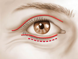 blepharoplastie