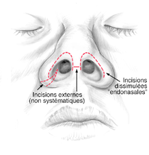 rhinoplastie2